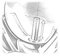 peg_setting.png